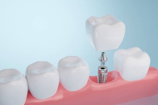 Transform Your Smile: Discover the Life-Changing Benefits of Tooth Implants